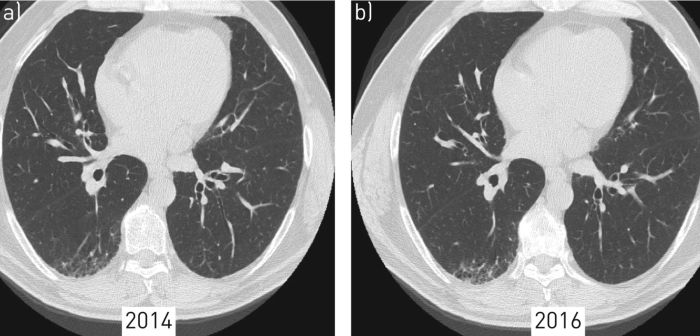 Parenchymal lung disease